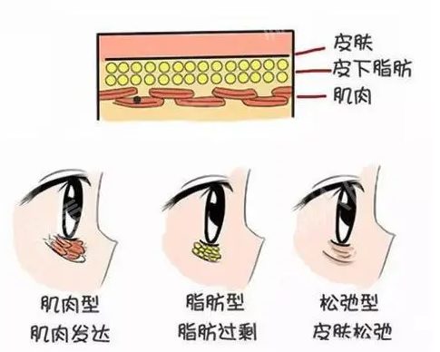 眼袋手术