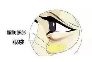 眼袋手术