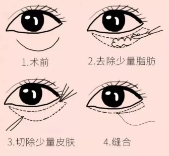 眼袋手术