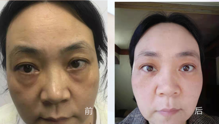 去眼袋手术