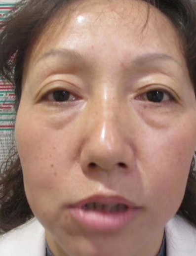 去眼袋手术