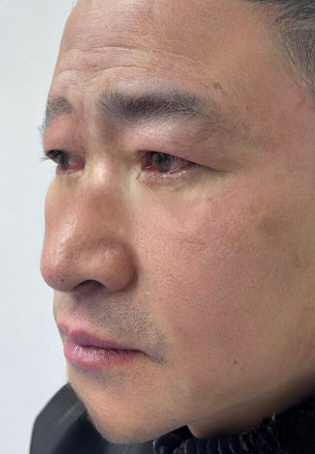 去眼袋手术