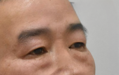 去眼袋手术