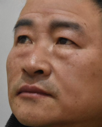 去眼袋手术