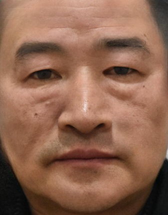 去眼袋手术