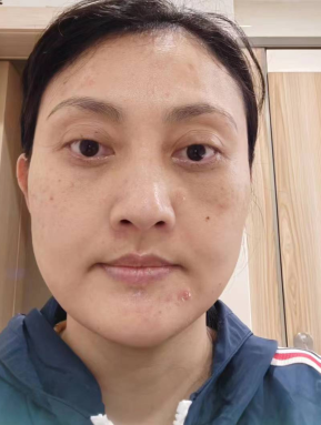 眼袋