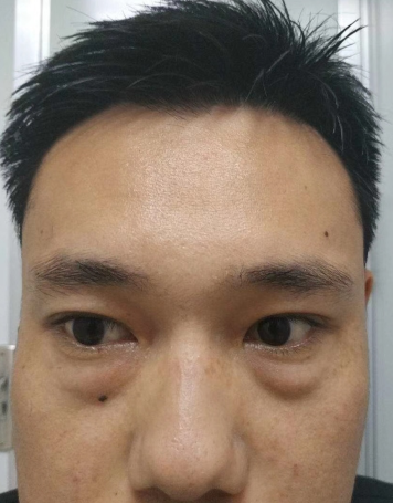 眼袋