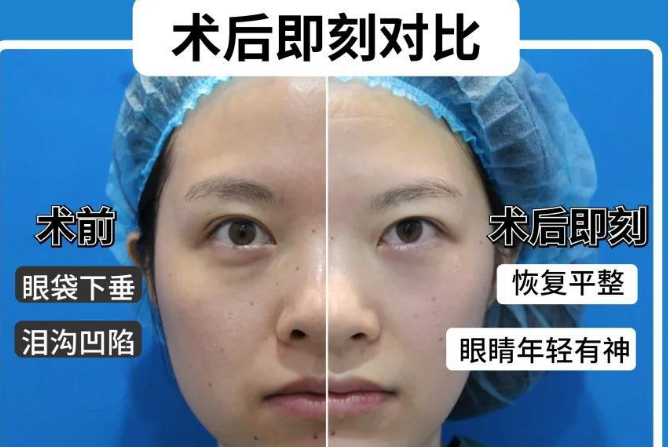 眼袋