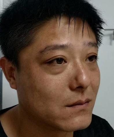 眼袋
