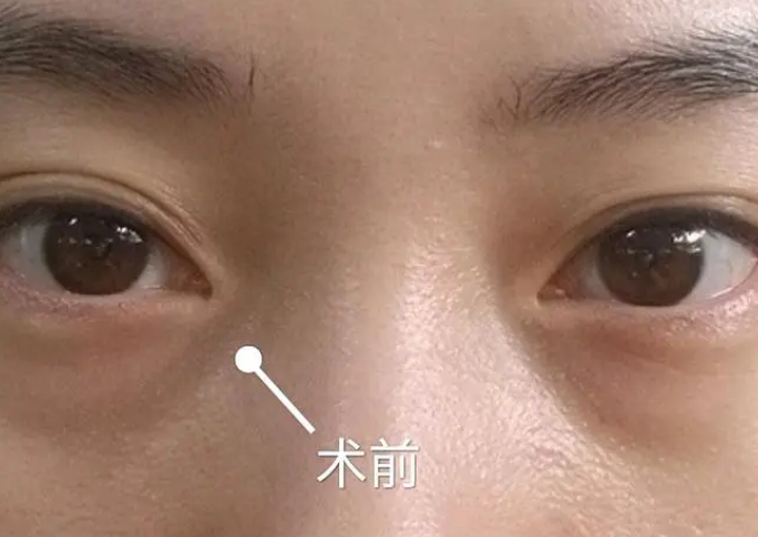 眼袋
