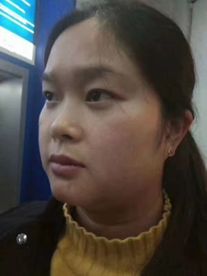 去眼袋手术