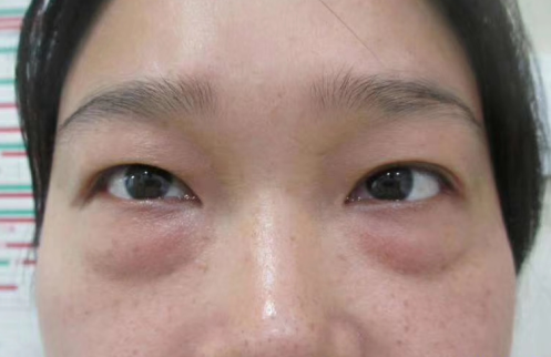 去眼袋手术