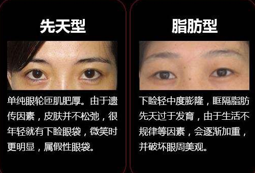 去眼袋手术