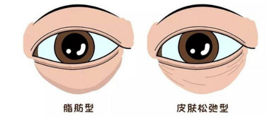 去眼袋手术
