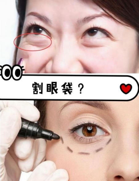 去眼袋手术