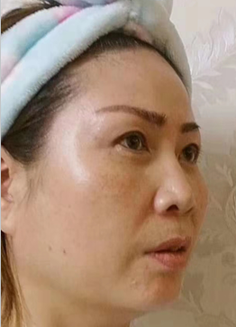 去眼袋手术