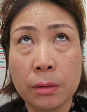 去眼袋手术