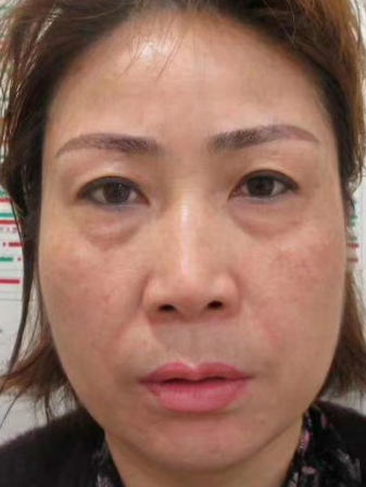 去眼袋手术