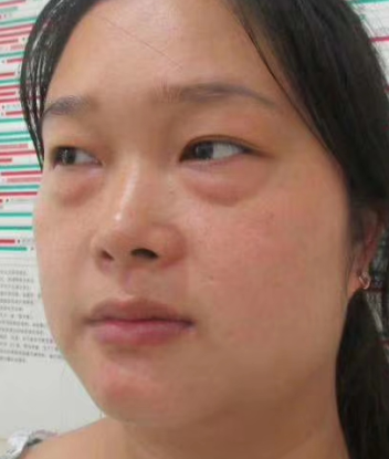 去眼袋手术
