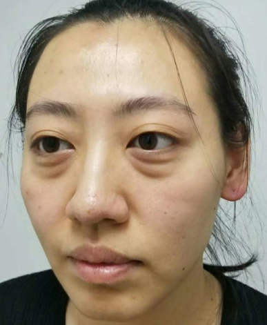 去眼袋手术