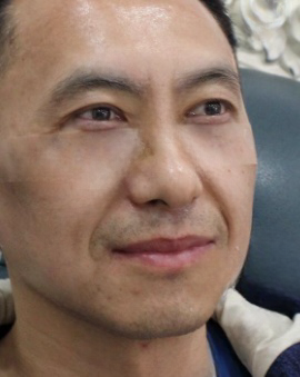 去眼袋手术