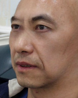 去眼袋手术