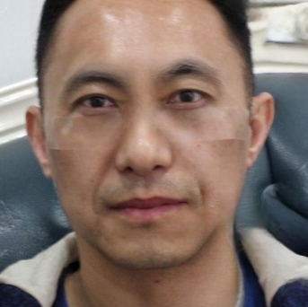 去眼袋手术