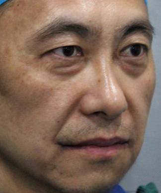去眼袋手术