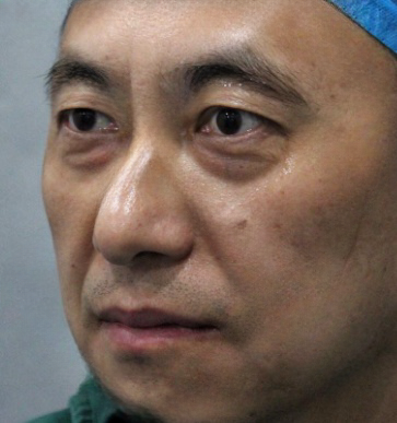 去眼袋手术