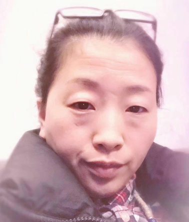 眼袋