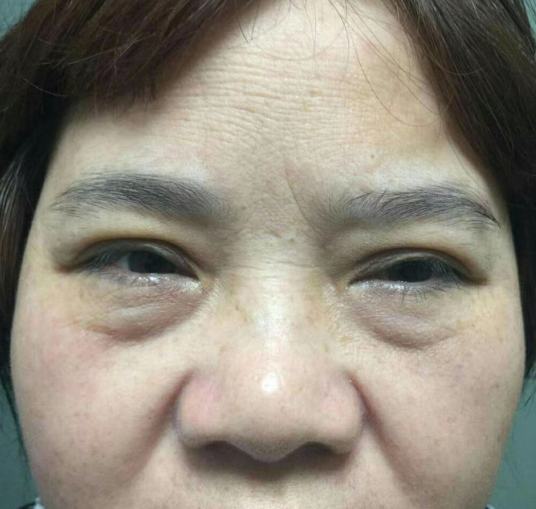 眼袋