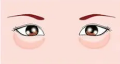 眼袋