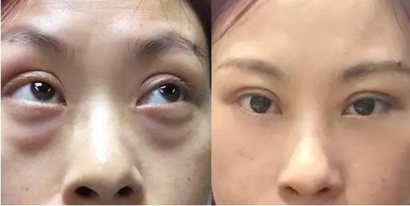 眼袋