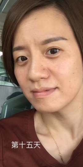 眼袋