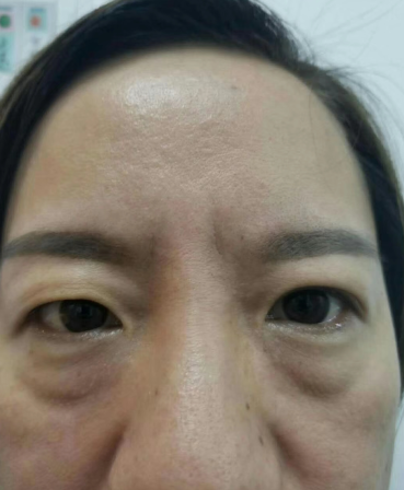 眼袋