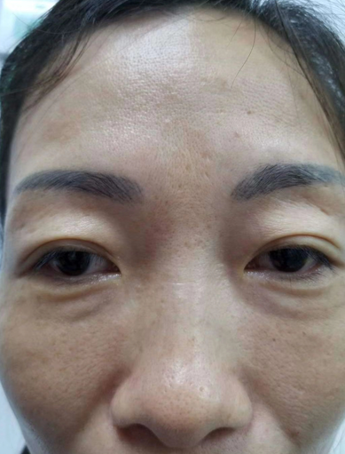 眼袋