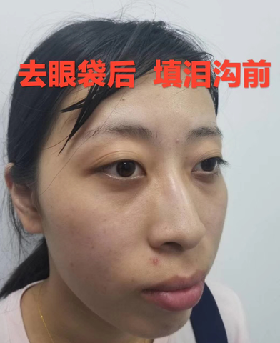 眼袋