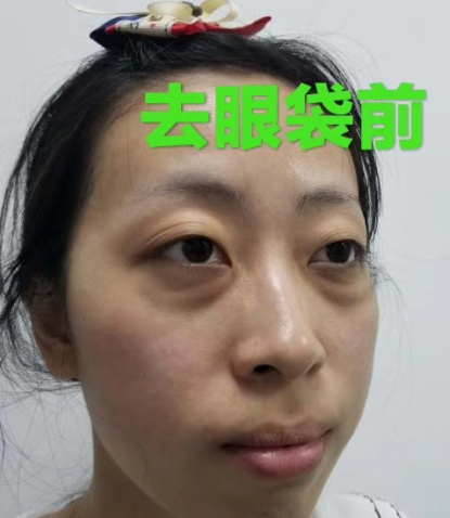 眼袋