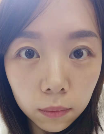 眼袋