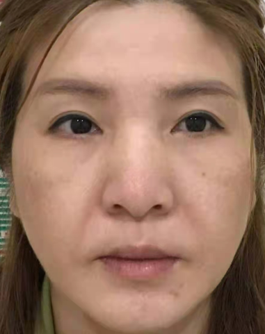 眼袋