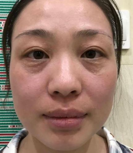 眼袋