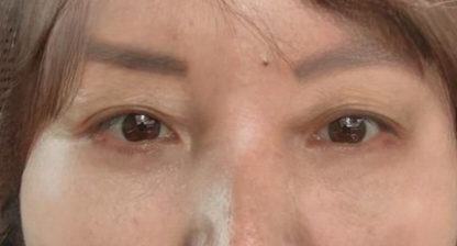 去眼袋手术