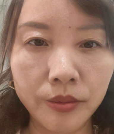 去眼袋手术