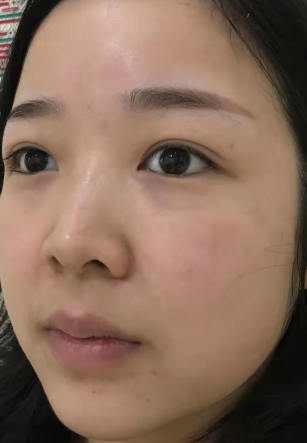 眼袋