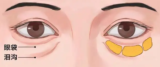 眼袋