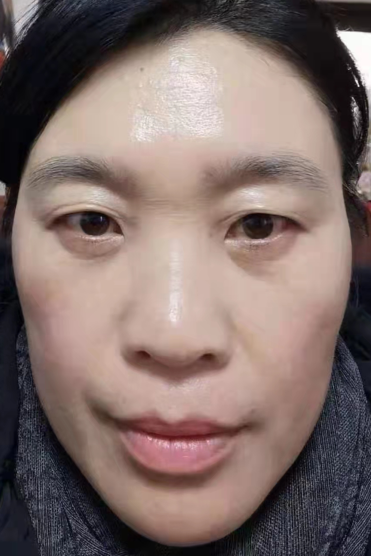 眼袋