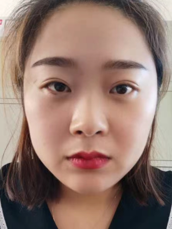 眼袋