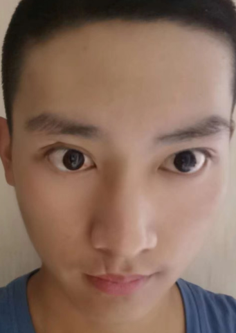 眼袋