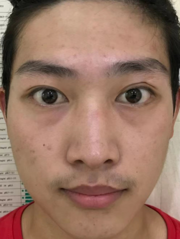 眼袋