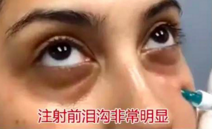 泪沟填充